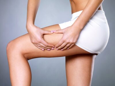 Cellulit BEZ TAJEMNIC!