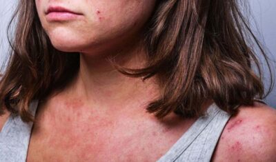 AZS – pielęgnacja skóry objętej atopią